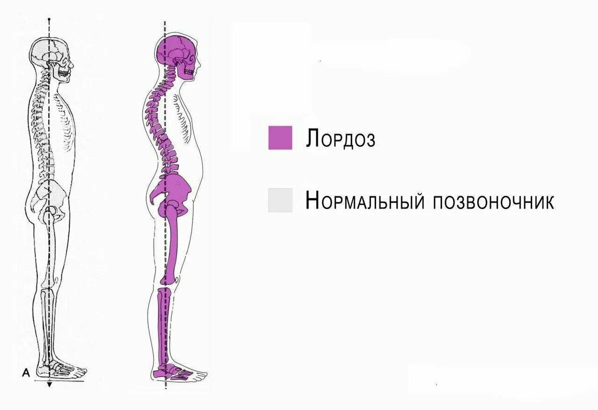 Гиперлордоз и выпирающий живот. Лордоз поясничного отдела позвоночника. Лордоз шейного отдела позвоночника. Лордоз поясничного отдела у ребенка. Лордоз поясничного отдела и гиперлордоз.