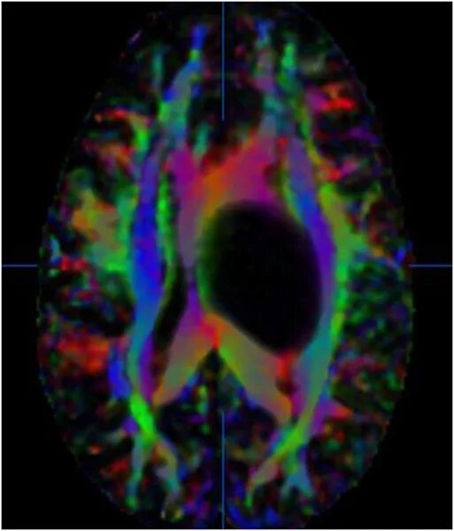 Diffusion tensor. Diffusion tensor imaging. clinical perfusion mri. mosaic pattern of perfusion.