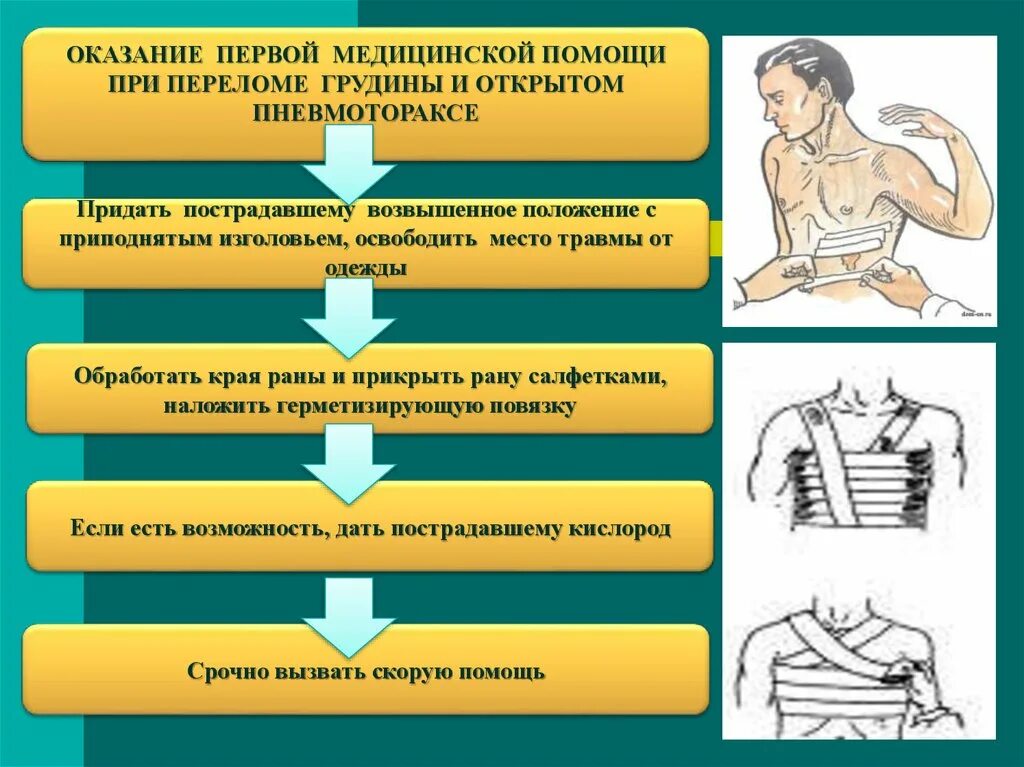 Алгоритм оказания ПМП переломе. Алгоритм первой помощи при ранении грудной клетки:. Оказание первой помощи при открытой травме грудной клетки. Травма грудной клетки первая помощь алгоритм.