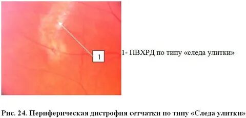 Дистрофия сетчатки улитки