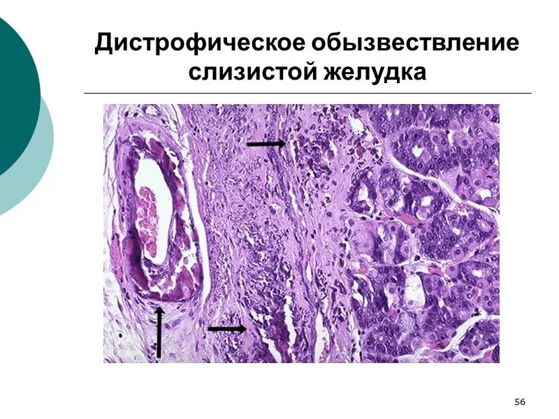 Кальцинация сосудов. Кальцинация сосудов
