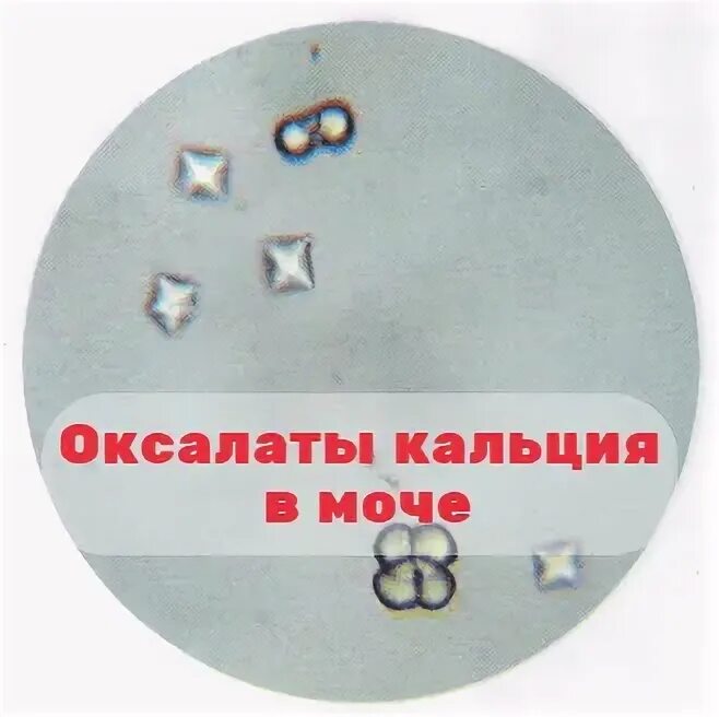 Повышены оксалаты кальция в моче. Оксалаты кальция в моче. Оксалат кальция моногидрат. Кристаллы оксалаты в моче. Кальция оксалат моногидрат из почки.