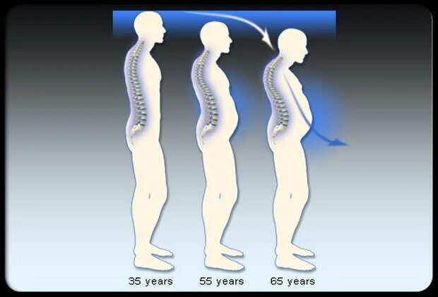 Возрастные изменения позвоночника. Старение осанка. Позвоночник в старости. Изменение позвоночника с возрастом. Возрастные изменения роста
