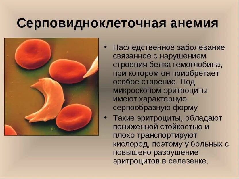 Серповидноклеточная анемия показатели крови. Серповидноклеточная анемия глутамат Валин. Серповидноклеточная анемия ретикулоциты. Серповидноклеточная анемия морфология. Серповидно клеточная анемия признаки