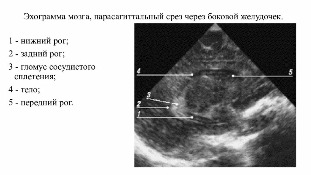 Ультразвуковая анатомия головного мозга плода. УЗИ анатомия НСГ. Задние рога боковых желудочков УЗИ. Расширение боковых рогов