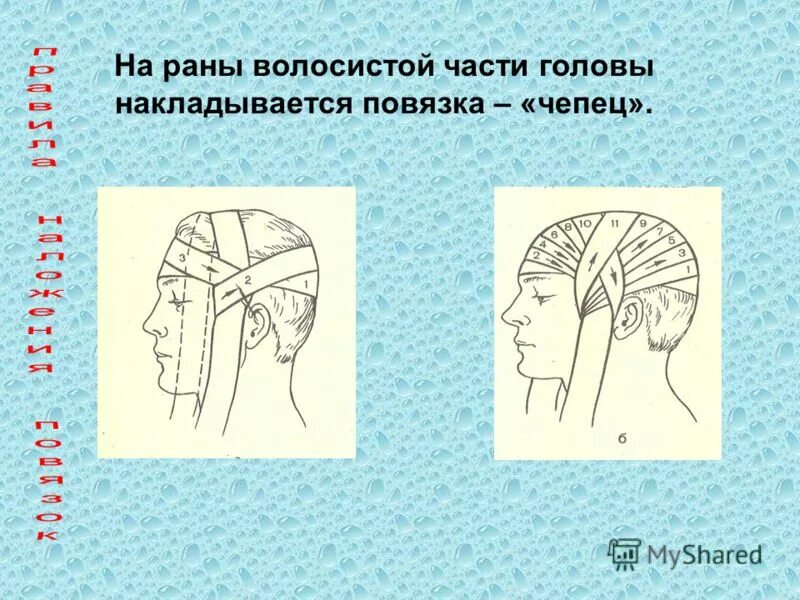 Повязка накладывается при повреждении затылка. При ранениях волосистой части головы накладывают повязку. Повязка чепец при ранении головы. Техника наложения повязки чепец. Наложение повязки при ранении волосистой части головы.