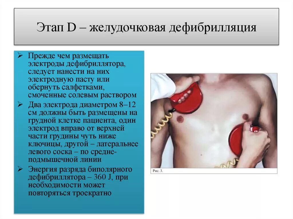 Порядок действий по использованию дефибриллятора