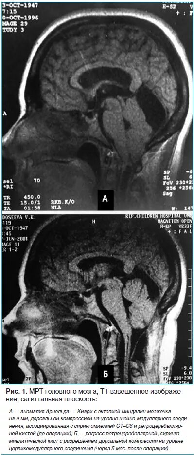 Аномалия киари степени. Арнольда Киари аномалия степени. Миндалины мозжечка аномалии. Мальформация Киари операция.