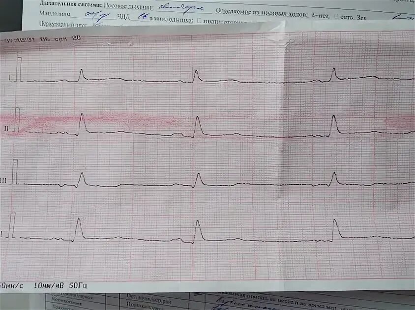 Сегмент смп. Экг подъем сегмента st в v2-v6. окс без подъема st на экг.