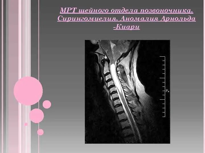 Сирингомиелия и сирингобульбия. Сирингомиелия грудного отдела мрт. Сирингомиелия шейного отдела позвоночника мрт. Сирингомиелия миелография. Гидромиелия сирингомиелия.