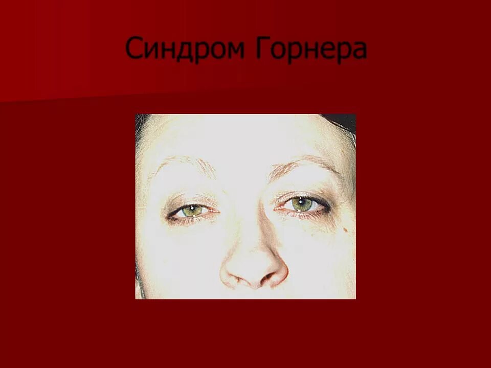 Синдром горнера это. Птоз миоз энофтальм синдром горнера. синдром клода бернара горнера. симптом бернара горнера. триада клода бернара горнера.