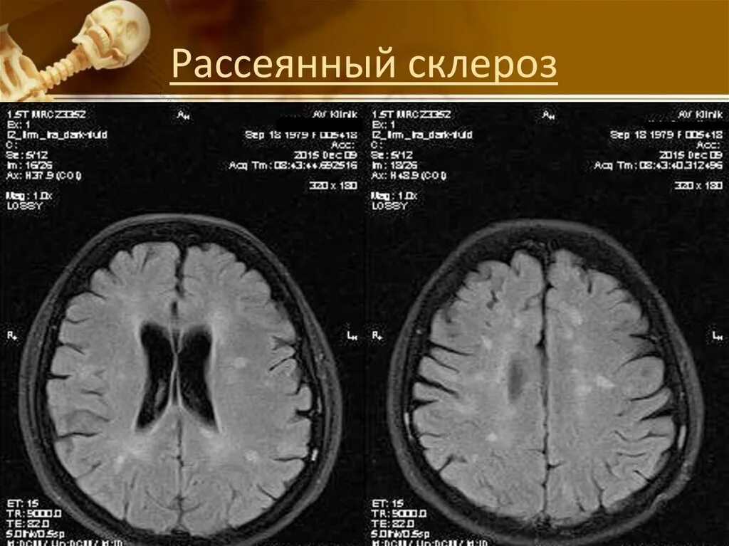 Склероз мозга. Рассеянный склероз. Рассеянный склероз рассеянный склероз. Рассеянный склероз аутоиммунное заболевание. Рассеивающий склероз.