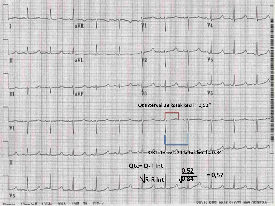 Удлиненное qt на экг. QTC норма ЭКГ. Qt QTC на ЭКГ норма. Норма интервала qt на ЭКГ У взрослых. Интервал qt/QTC норма.