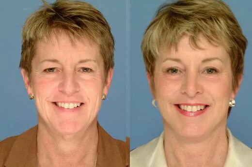 Броулифтинг до и после отзывы Brow Lift Before and After: Say Goodbye to Sagging Brows and Forehead Wrinkles