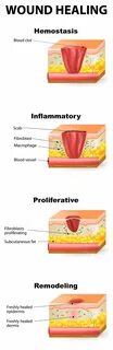 Wound healing