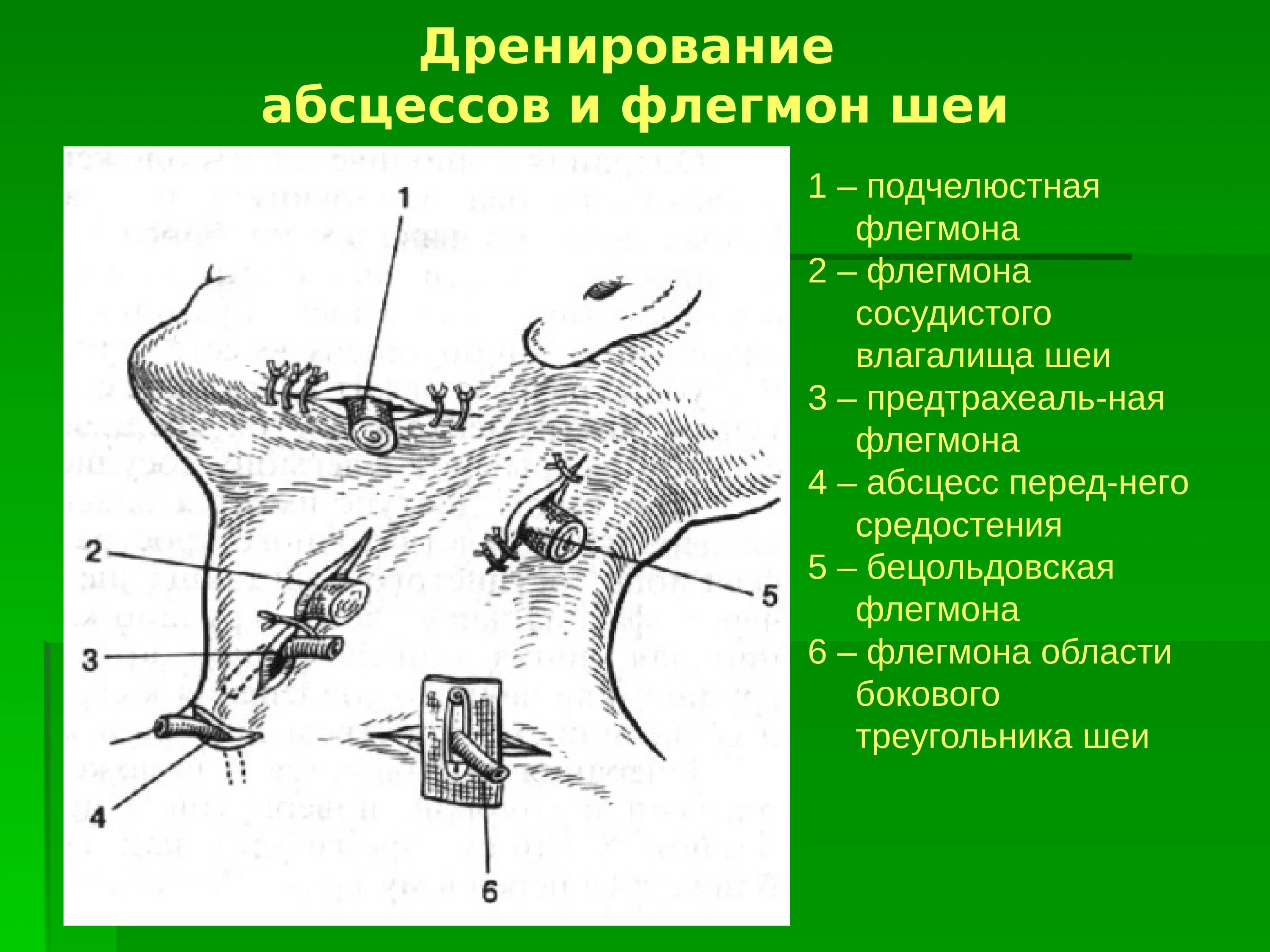 Флегмона клетчаточного пространства шеи. Дренирование флегмон шеи. Флегмона лампасные разрезы. Дренирование абсцессов и флегмон шеи. Операция абсцесс шеи