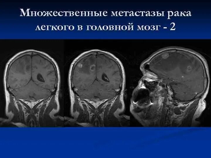 Лечение метастазов мозга. Метастатические опухоли головного мозга. Метастазы в головном мозге. Опухоль головного мозга метастазы. Метастазы головного мозга кт.