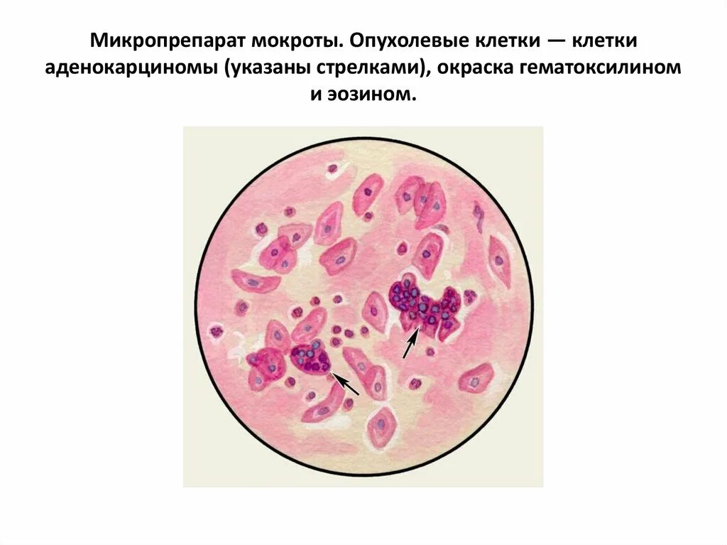 Образование мокроты. Клеточные элементы мокроты. Мокрота окрашенная микроскопия.