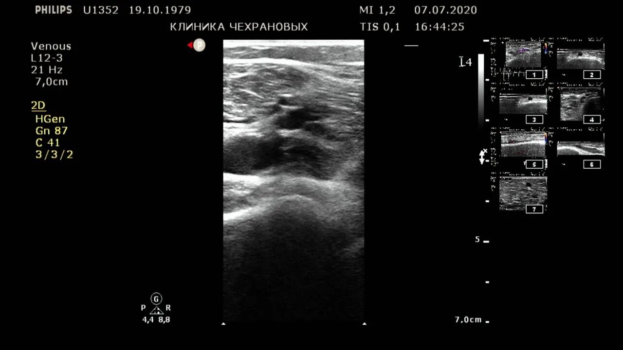 Как называется узи вен. Заболевание вен нижних конечностей на УЗИ. Патология вен нижних конечностей на УЗИ. Открытый артериальный проток на УЗИ.