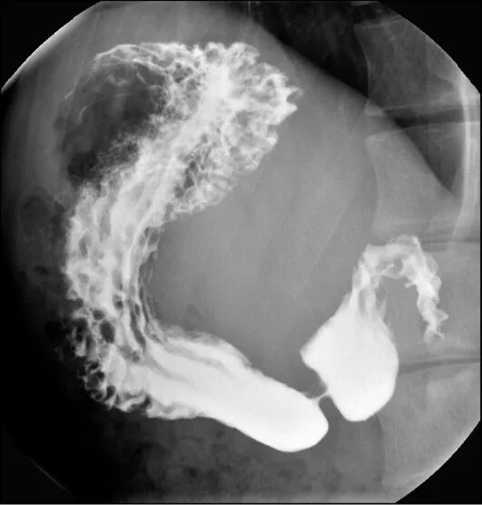 рентген с барием спб. рентген с барием пищевода и желудка. контрастирование желудка сульфатом бария. рентген с барием спб. рентгеноскопия желудка с барием дпк.