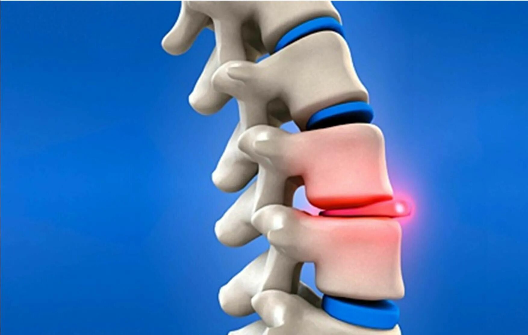 Центр здоровья позвоночника. Протрузия Шморля. Межпозвоночная грыжа позвоночника. Грыжа диска.