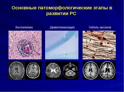 Возникновение рассеянного склероза