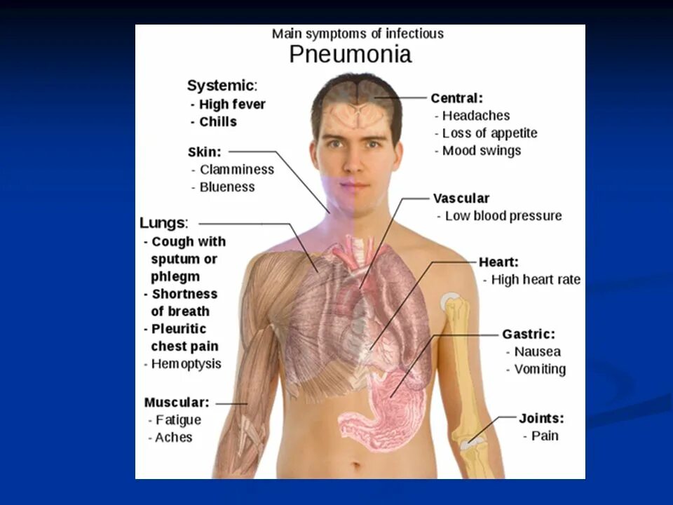 пневмония болит рука. основные симптомы пневмонии. пневмония болит рука. симптомы при двухсторонней пневмонии у ребенка. внебольничная пневмония.