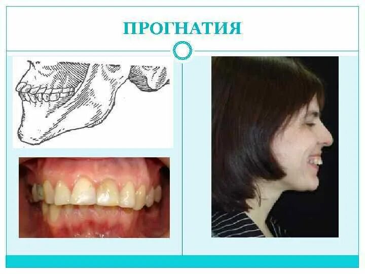 неправильный прикус прогения. верхняя челюсть вперед у ребенка. мезиальный прикус прикус. верхняя челюсть вперед у ребенка. типы прикусов зубов у человека.