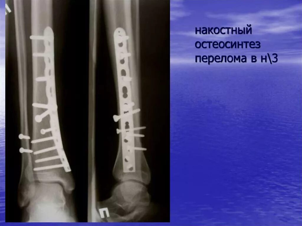 Перелом Вуальмье остеосинтез. Накостный остеосинтез пластинами. Перелом большеберцовой кости остеосинтез. Остеосинтез перелома берцовой кости. Перелом н 3