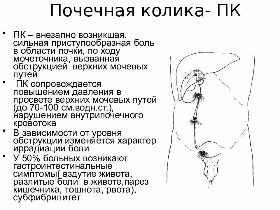 Иррадиация почечной колики. Болевые точки при почечной колике. Положение больного при почечной колике. Иррадиация боли при почечной колике. Типичная иррадиация болей при почечной колике.