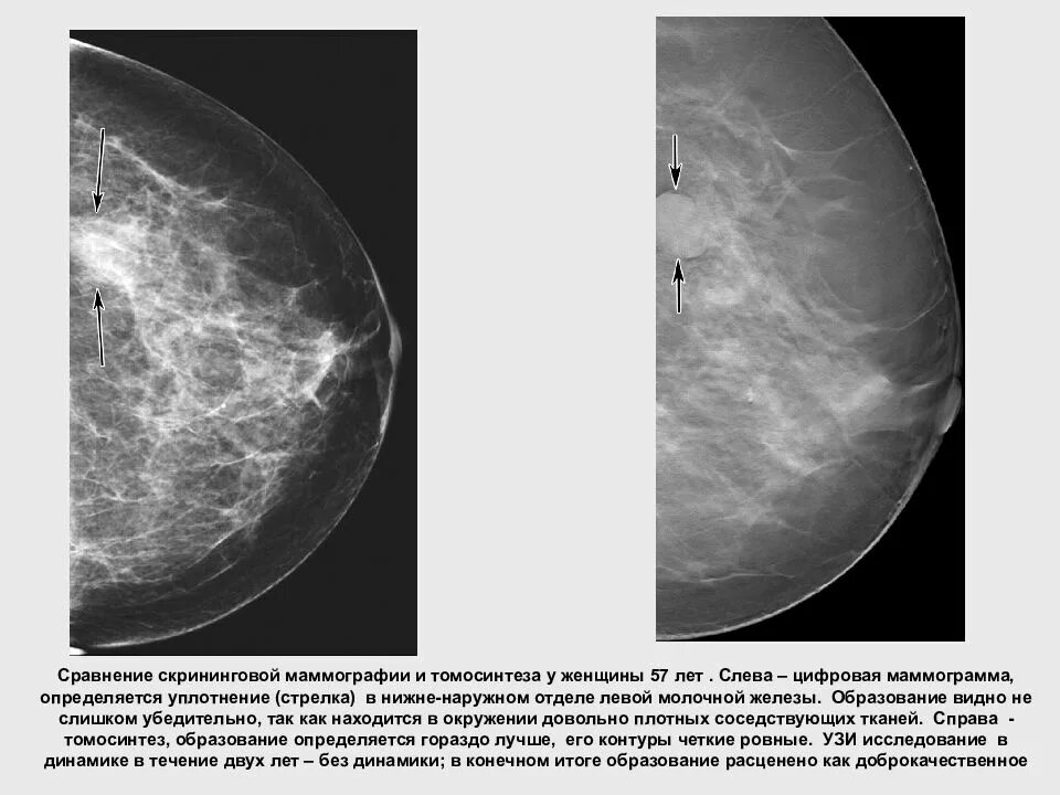 Норма молочной железы маммограмма. Фиброзно-кистозная мастопатия рентген. Фиброзно кистозная мастопатия маммограмма. Маммография рентген молочной железы. Лимфоузел молочной железы маммография