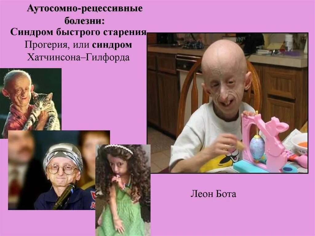 Гутчисон гилфорд прогериа. Старение кожи. Прогерия синдром хатчинсона. Преждевременное старение. Быстрое старение болезнь.