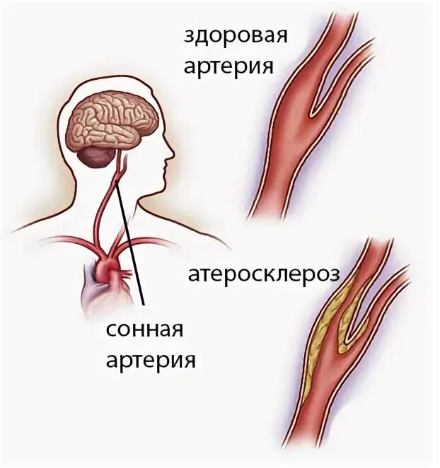 Операциянасоннаяартерии. Операция на сонной артерии. Атеросклероз сонных артерий.