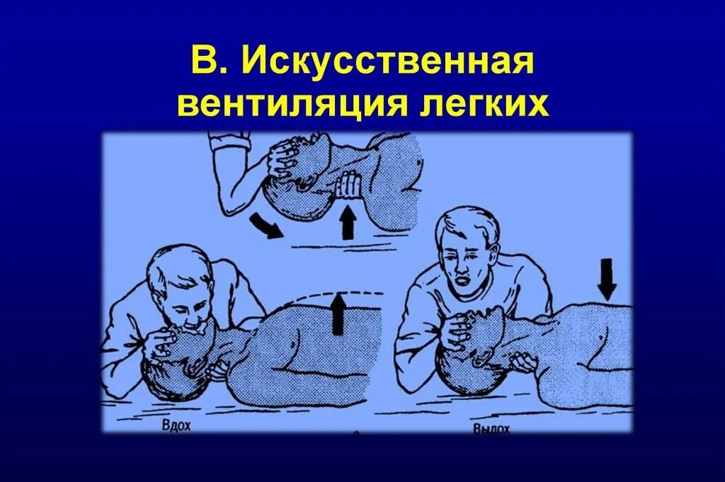 Искусственная вентиляция легких (ивл). Аппаратные методы искусственного дыхания. Способы искусственного дыхания. Схема выполнения искусственного дыхания. Методы проведения искусственного дыхания.
