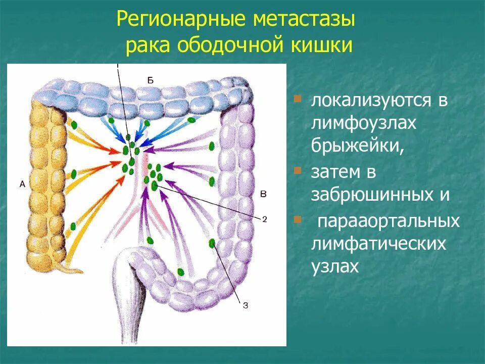 Метастазы при раке сигмовидной кишки. Регионарные лимфоузлы толстой кишки. регионарные лимфатические узлы ободочной кишки. регионарные лимфоузлы сигмовидной кишки. регионарные лимфоузлы толстого кишечника.