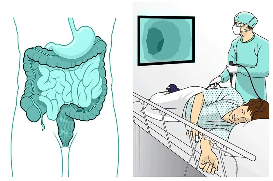 Колоноскопия фиброколоноскопия. Исследование толстой кишки колоноскопия. Эндоскопическое исследование толстой кишки (колоноскопия) с наркозом. Как правильно вставить кишку