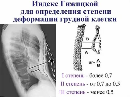Смещаемость грудины