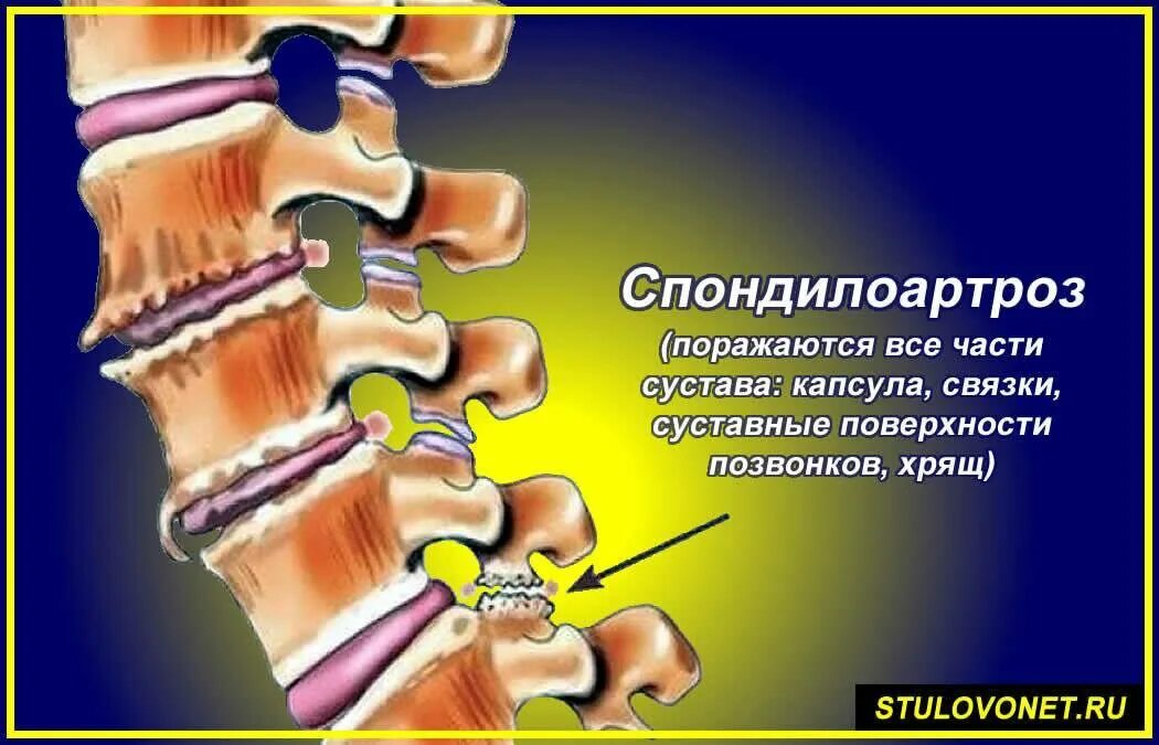 Что значит спондилоартроз пояснично крестцового. Спондилоартроз с6-th1. спондилез позвоночника. спондилоартроз c3c4. спондилоартроз th5 - th12..