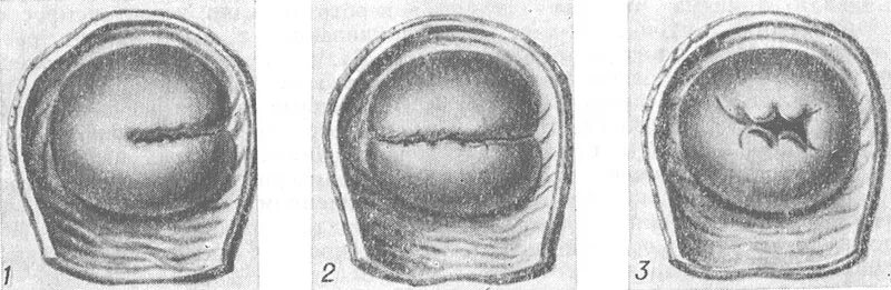 Плотный раскрытый. Рубцевание тканей шейки матки. Рубцовая деформация шейки матки. Наружный зев шейки матки щелевидный. Наружный зев щелевидный что это.