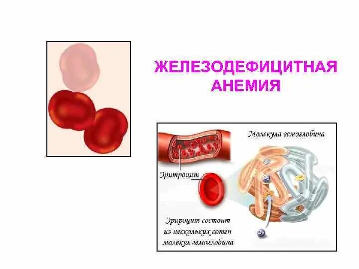 Пациент с железодефицитной анемией. Железодефицитная анемия симптомы. основные симптомы железодефицитной анемии.