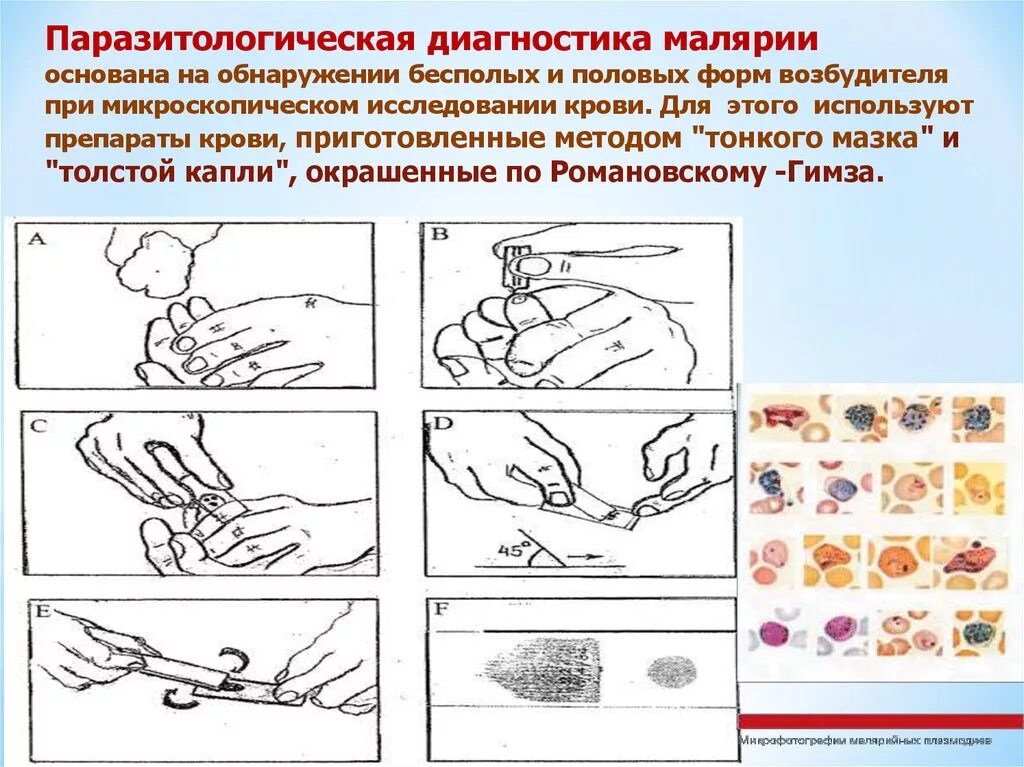 Малярия тестирование. Исследование толстой капли крови на малярию. Приготовление мазка и толстой капли крови на малярию. Исследование толстой капли и мазка крови на малярию. Приготовление толстой капли и тонкого мазка при малярии.