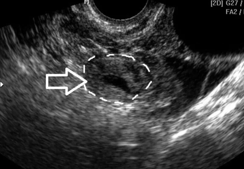 Внематочная беременность в трубе УЗИ. Маточная беременность УЗИ. Внематочная беременность плодное яйцо. Внематочная Трубная беременность УЗИ.