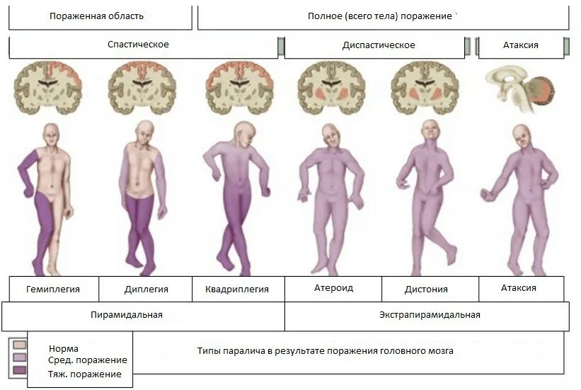 ДЦП формы спастическая гемиплегия. ДЦП В легкой форме симптомы у детей. Формы ДЦП неврология. Формы ДЦП таблица.