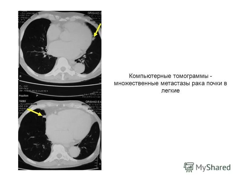 Множественные метастазы в легких на кт. Множественные метастазы в лёгких кт.