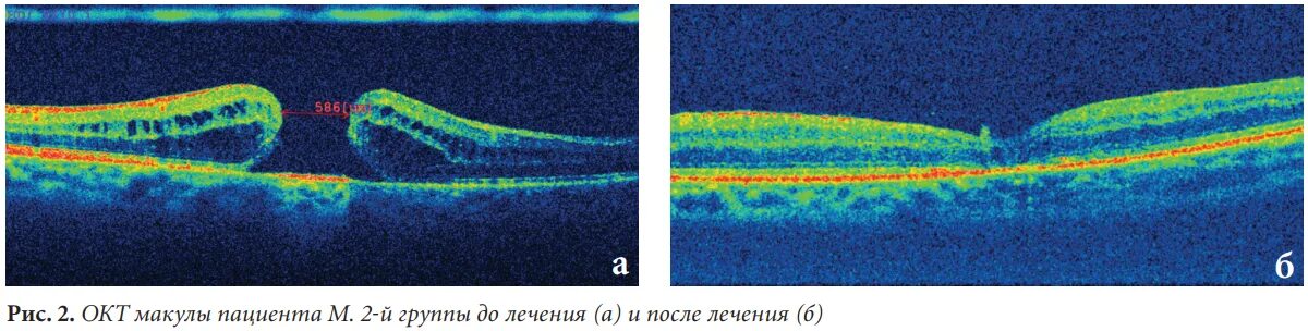 Оптическая когерентная томография сетчатки глаза. Оптическая когерентная томография. Когерентная томография зрительного нерва. Окт макулы обоих глаз. Макулопатия макулярный отек.