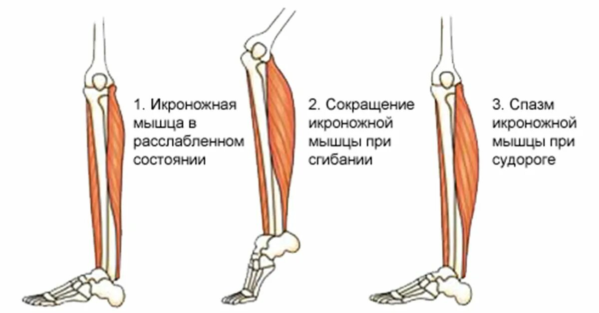 Почему ноги напряжены. Мышцы стопы при судорогах. Спазмируются икроножные мышцы. Спазм мышц икроножной мышцы. Свело икроножную мышцу.