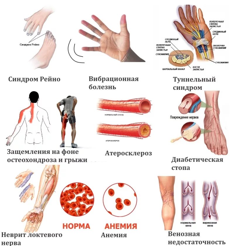 Анемия стоп. Мазь от онемения конечностей ног. Онемения рук и ног лекарство. Лекарство от парестезии конечностей. Таблетки от онемения и одеревенения конечностей.