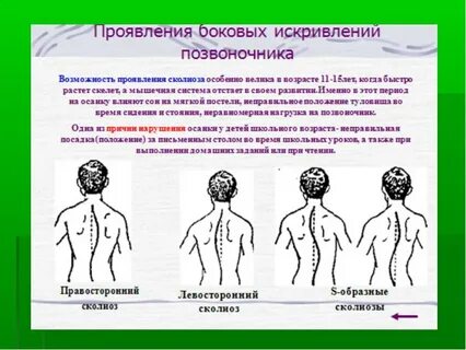 Левосторонний деформация позвоночника
