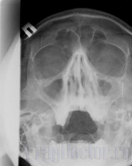 Верхнечелюстной синусит рентген. Рентгенография придаточных пазух носа гайморит. Рентген гайморовых пазух норма. Пристеночный отек слизистой