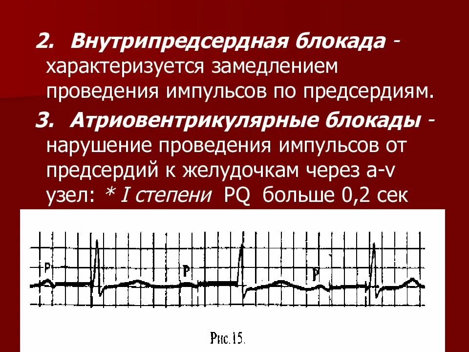 Что значит внутрипредсердная внутрипредсердная блокада. Признаки внутрипредсердной блокады на ЭКГ. Внутрипредсердная блокада на ЭКГ характеризуется. Внутрипредсердная блокада с АВ блокадой что это. Внутрипредсердная блокада 3 степени ЭКГ.